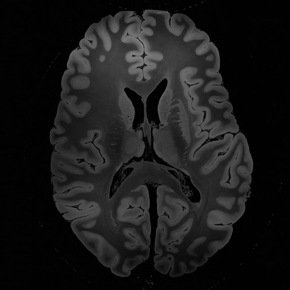 7 Tesla MRI of the ex vivo human brain at 100 micron resolution (100 micron MRI acquired FA25 axial).webm