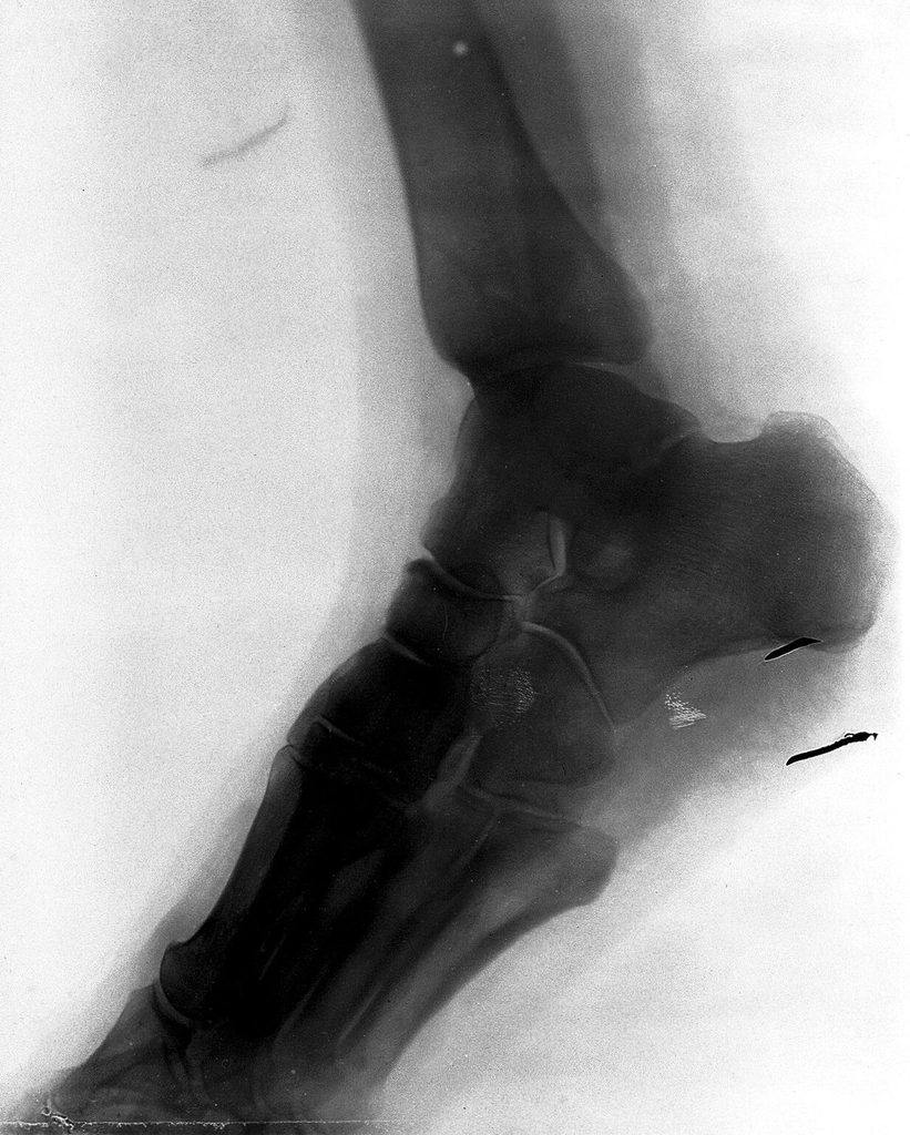 Bones ankle, part foot leg